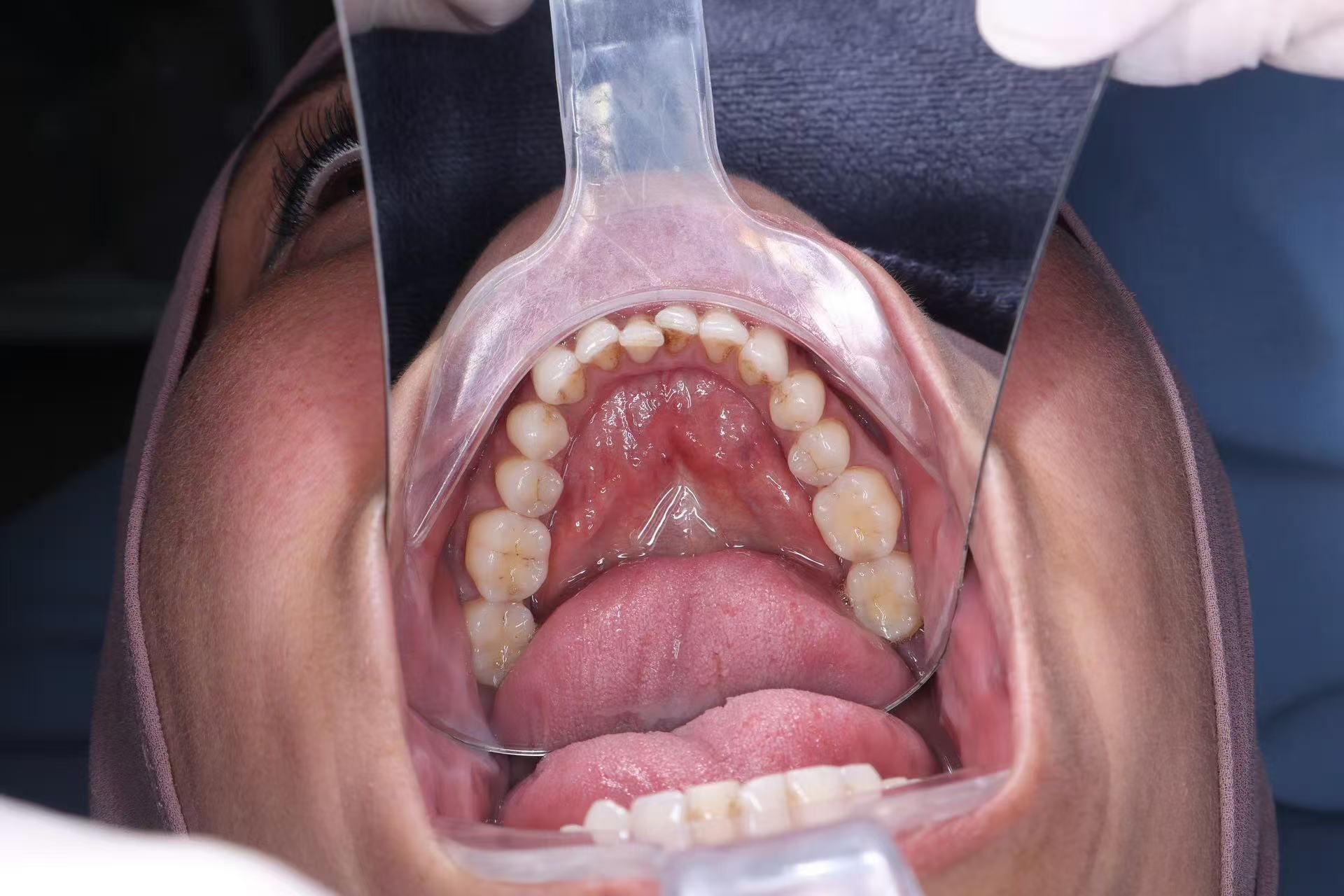 Affordable Dental Implants in Vietnam