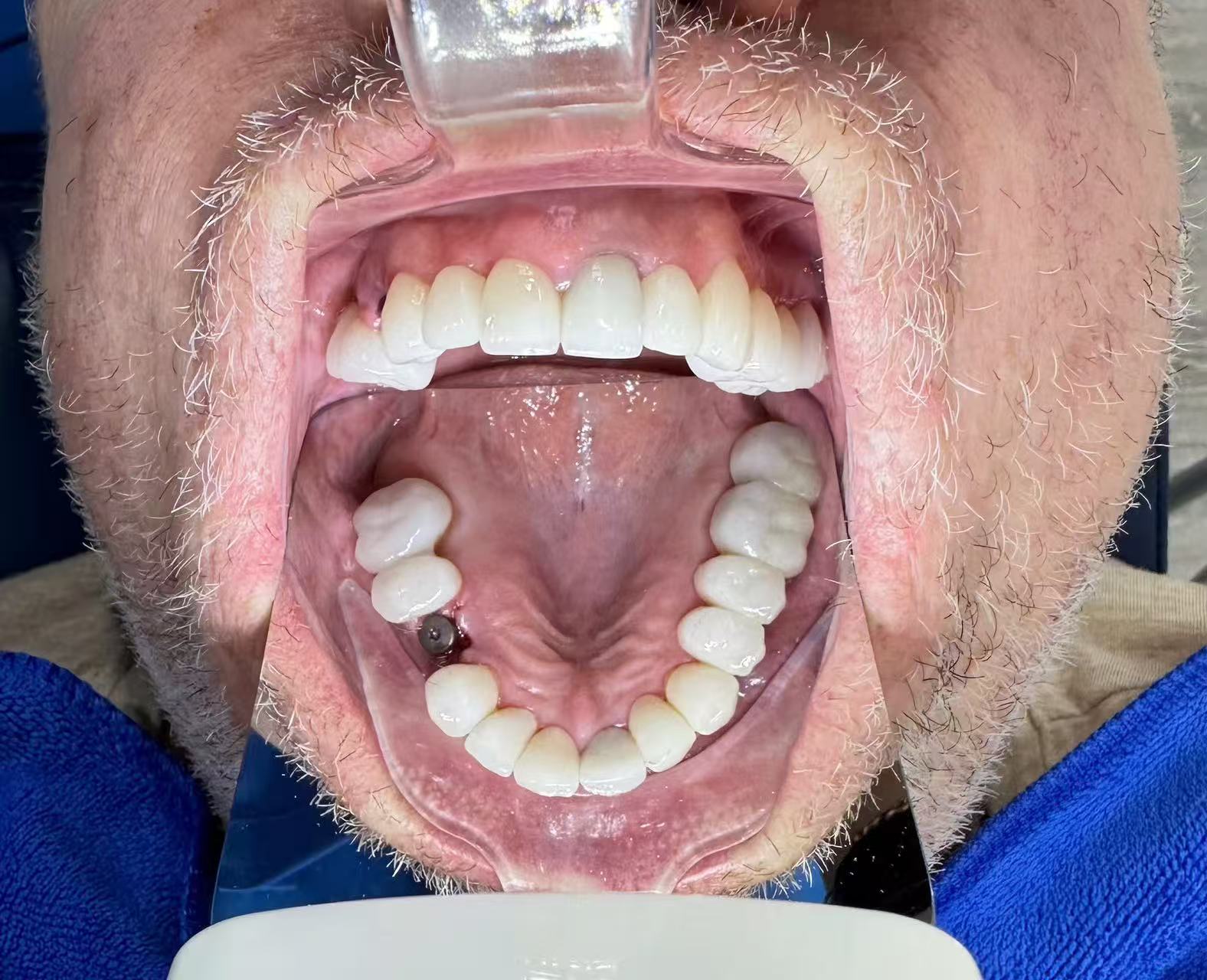 Screwless Dental Implants in Vietnam