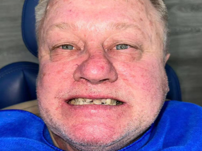 Dental Implants Explained