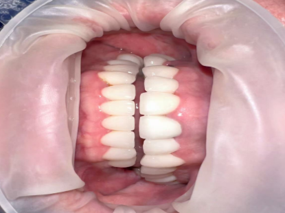 screwless dental implants cost