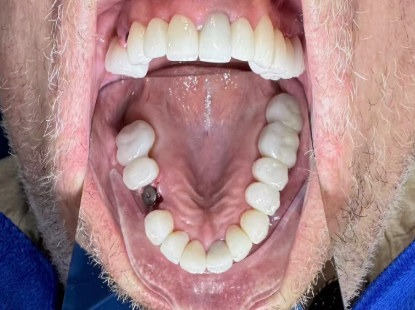 Screwless Dental Implants in Vietnam