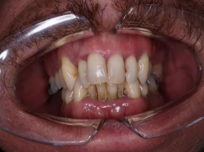 Vietnam Implant Denture