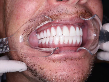 How Much Do Screwless Dental Implants Cost?