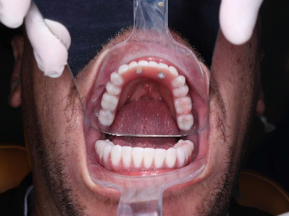 I want all my teeth removed and replaced