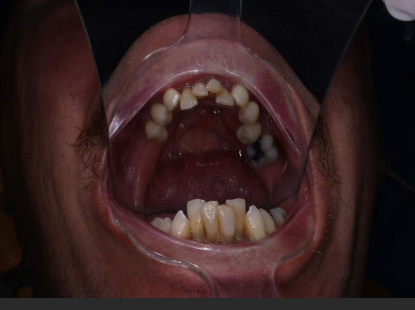 Dental Implants: Benefits, Process, and Long