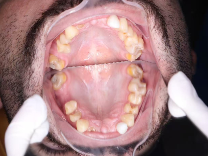 Dental Implant Cost for Seniors 2026