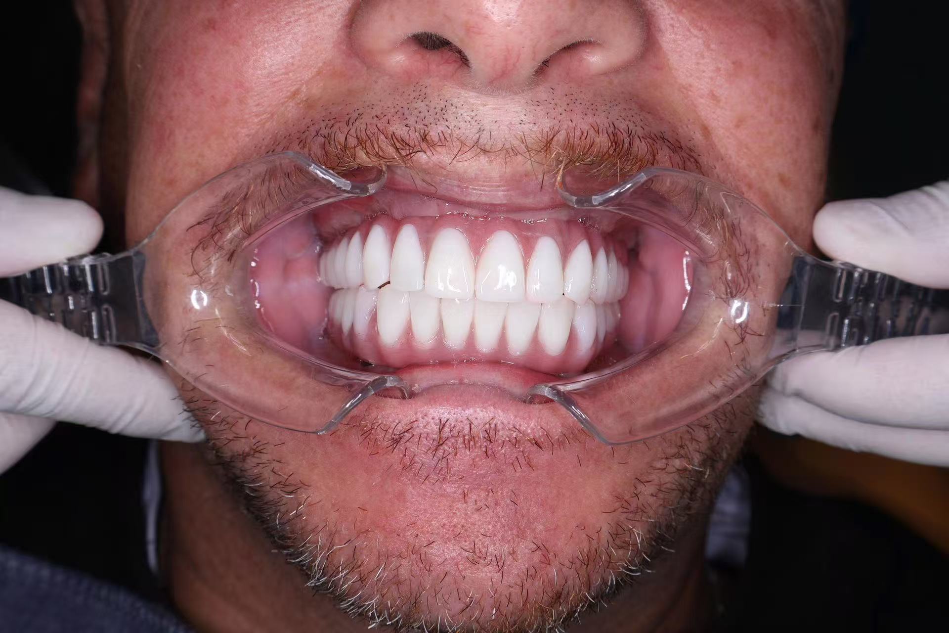 32 Dental Implants Prices: What Full-Mouth Implant Costs Really Mean in Practice