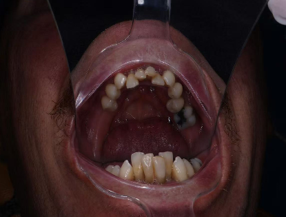 How Much Does a Full Set of Teeth Implants Cost